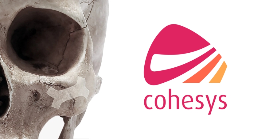 Cohesys Reports First-in-Human for BoneTape Craniofacial Fracture Repair
